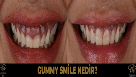 Gummy Smile Nedir?