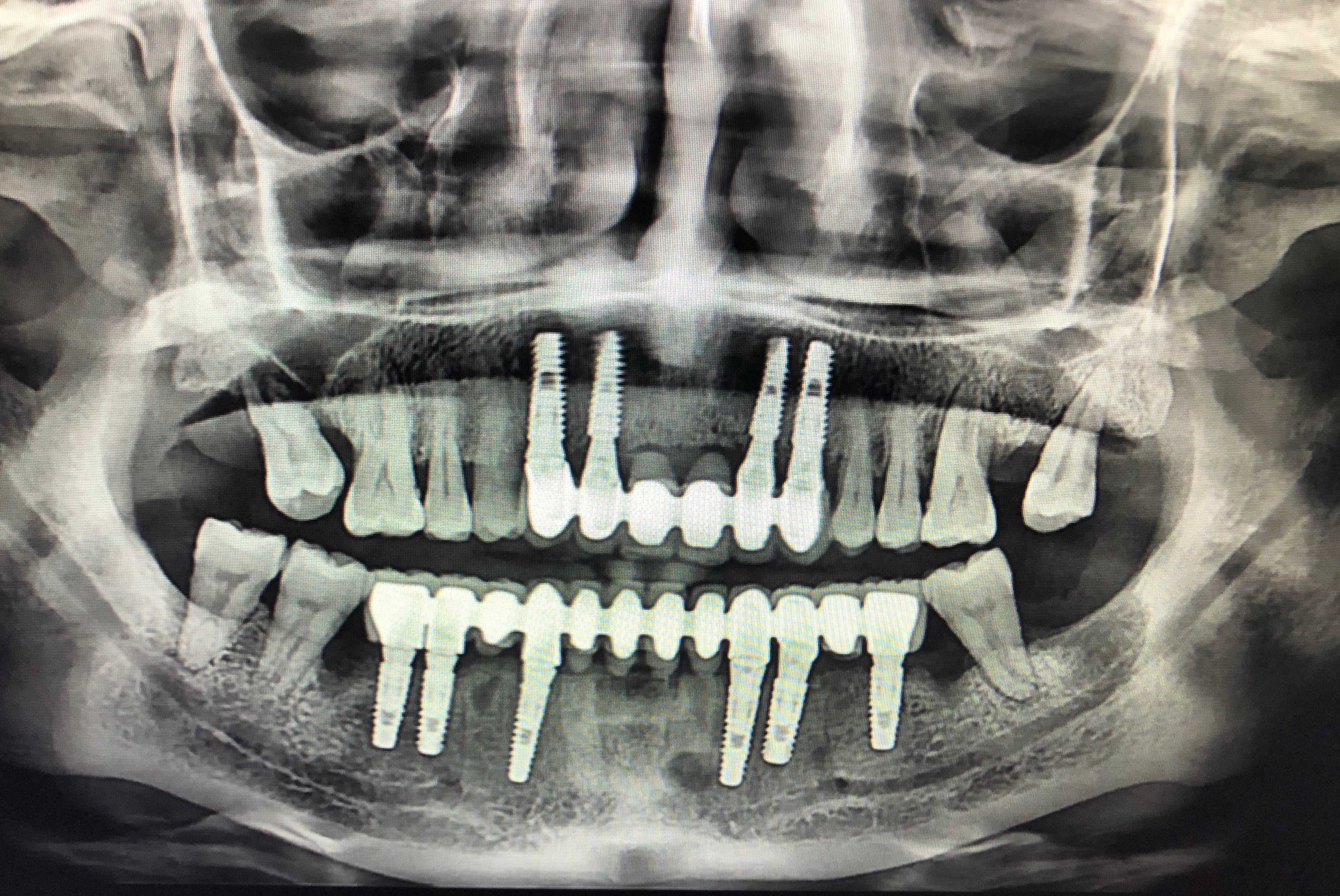 Crown Dental Tedavi